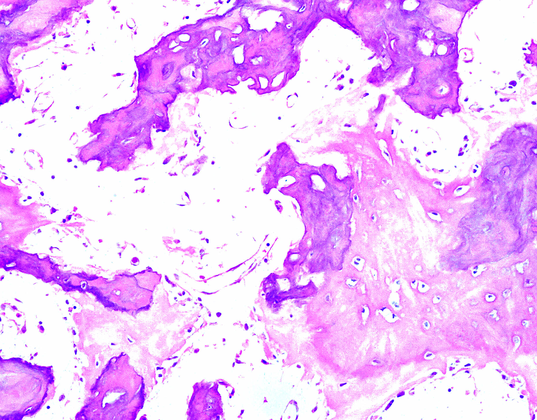 Pathology Outlines Paget Disease